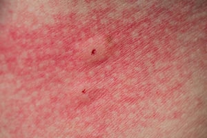 Close-up of red, irritated skin, likely a spider bite. Two small dark marks are visible within the inflamed area.