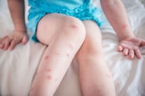 Mosquito Bites On Child Leg